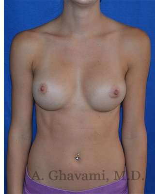 Breast Augmentation Before & After Patient #9088