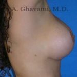 Breast Lift Before & After Patient #8807
