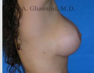 Breast Lift Before & After Patient #8807