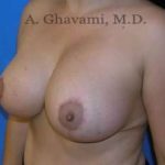 Breast Lift Before & After Patient #8807
