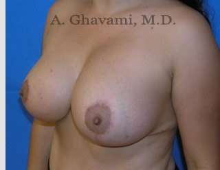 Breast Lift Before & After Patient #8807