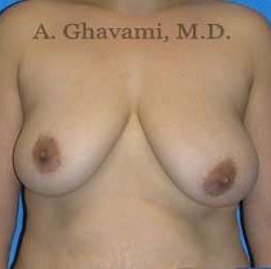 Breast Lift Before & After Patient #8807