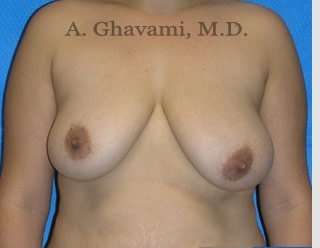 Breast Lift Before & After Patient #8807