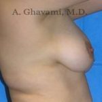 Breast Lift Before & After Patient #8807