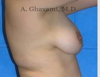 Breast Lift Before & After Patient #8807