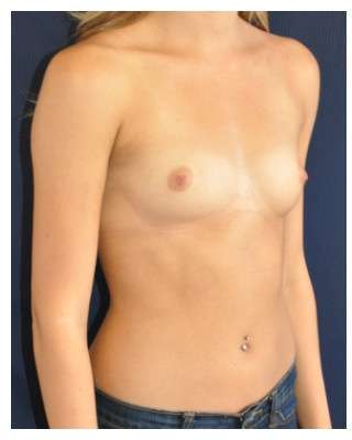 Breast Augmentation Before & After Patient #9088
