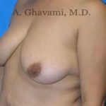 Breast Lift Before & After Patient #8807