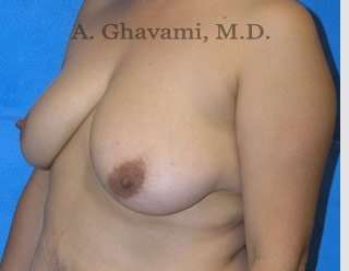 Breast Lift Before & After Patient #8807