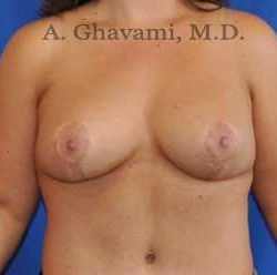 Breast Lift Before & After Patient #8800