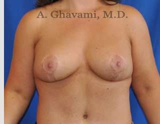 Breast Lift Before & After Patient #8800