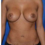 Breast Augmentation Before & After Patient #9081