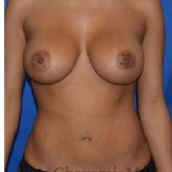 Breast Augmentation Before & After Patient #9081