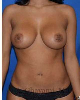 Breast Augmentation Before & After Patient #9081