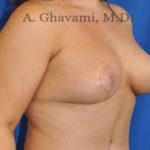 Breast Lift Before & After Patient #8800