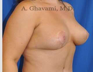Breast Lift Before & After Patient #8800