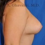 Breast Lift Before & After Patient #8800