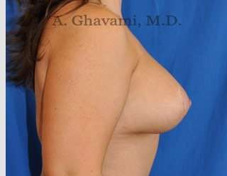Breast Lift Before & After Patient #8800