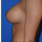 Breast Augmentation Before & After Patient #9081