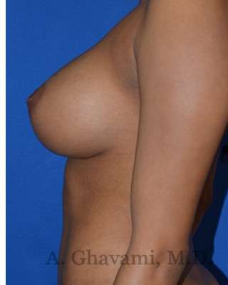 Breast Augmentation Before & After Patient #9081