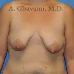 Breast Lift Before & After Patient #8800