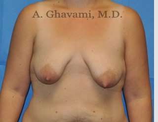 Breast Lift Before & After Patient #8800