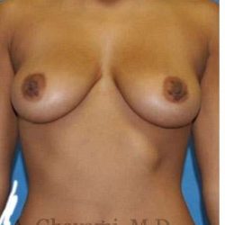 Breast Augmentation Before & After Patient #9081