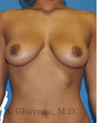 Breast Augmentation Before & After Patient #9081