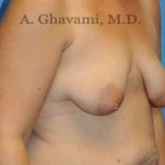Breast Lift Before & After Patient #8800