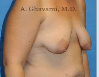 Breast Lift Before & After Patient #8800