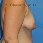 Breast Lift Before & After Patient #8800