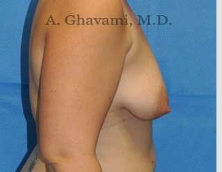 Breast Lift Before & After Patient #8800