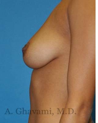 Breast Augmentation Before & After Patient #9081