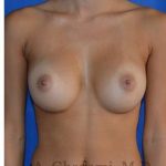Breast Augmentation Before & After Patient #9074