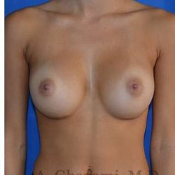 Breast Augmentation Before & After Patient #9074