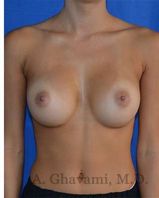 Breast Augmentation Before & After Patient #9074