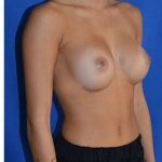 Breast Augmentation Before & After Patient #9074