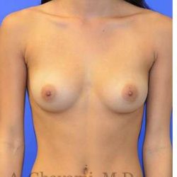 Breast Augmentation Before & After Patient #9074