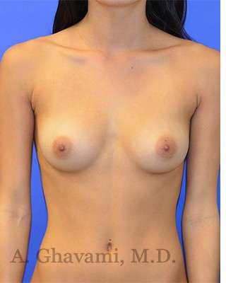 Breast Augmentation Before & After Patient #9074