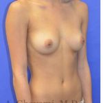 Breast Augmentation Before & After Patient #9074