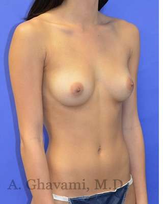Breast Augmentation Before & After Patient #9074