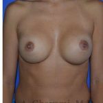 Breast Augmentation Before & After Patient #9067