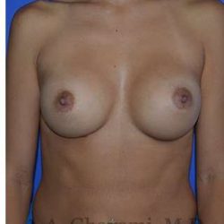 Breast Augmentation Before & After Patient #9067