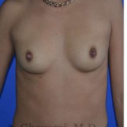 Breast Augmentation Before & After Patient #9067