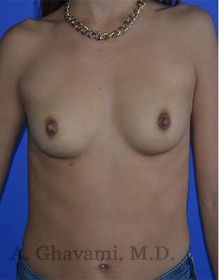 Breast Augmentation Before & After Patient #9067