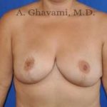 Breast Lift Before & After Patient #8779