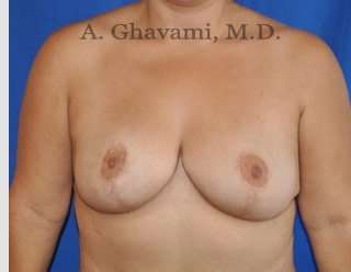 Breast Lift Before & After Patient #8779