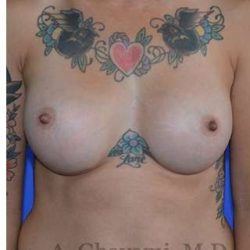 Breast Augmentation Before & After Patient #9060