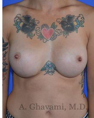 Breast Augmentation Before & After Patient #9060