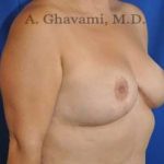 Breast Lift Before & After Patient #8779