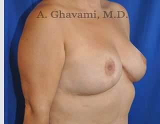 Breast Lift Before & After Patient #8779